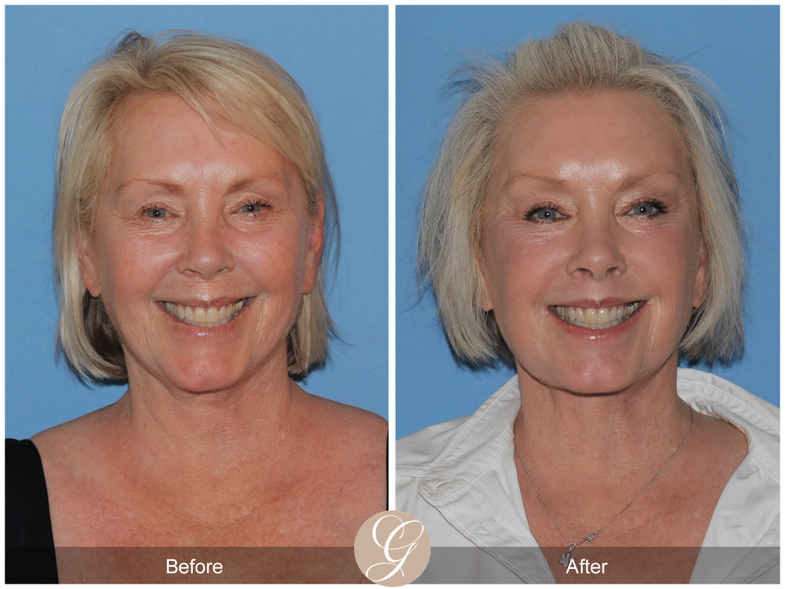 Preservation Deep Plane Facelift Case 48 Image