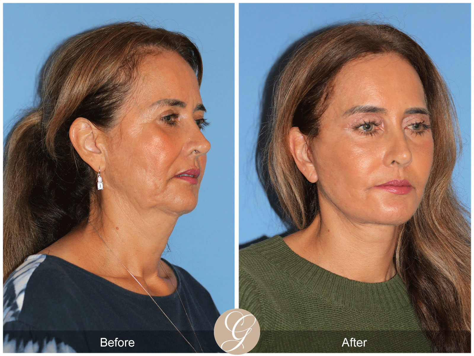 Preservation Deep Plane Facelift Case 49 Image