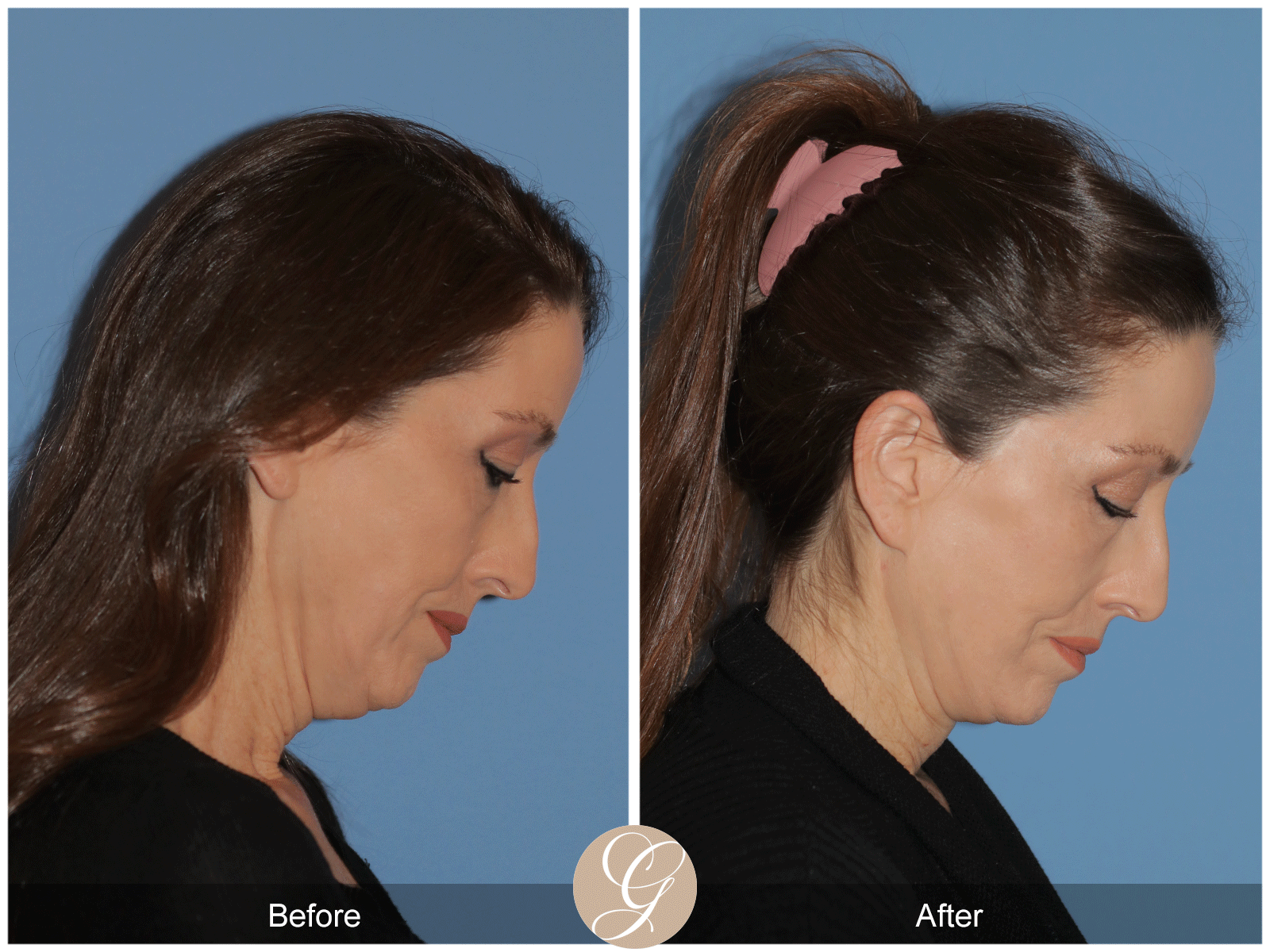 Deep Plane Facelift Case 38 Image