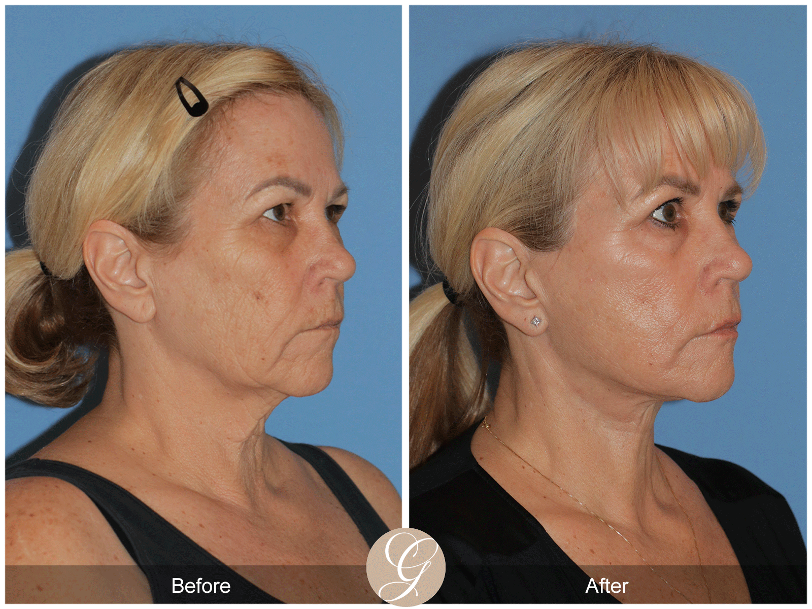 Deep Plane Facelift Case 38 Image