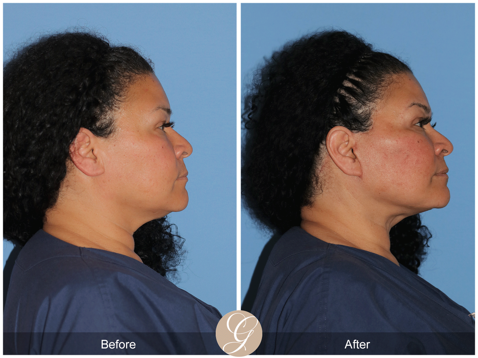 Deep Plane Facelift Case 40 Image