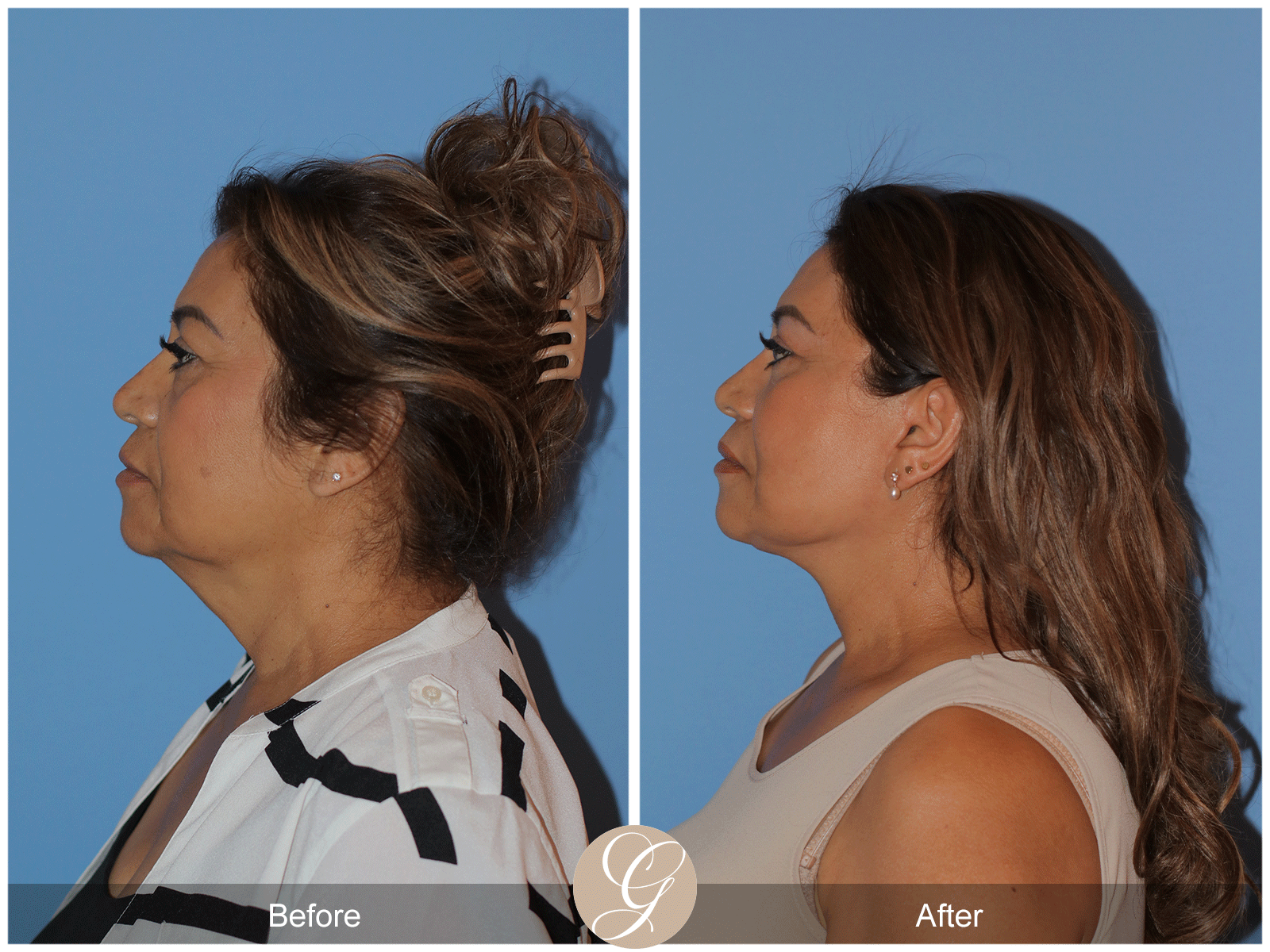 Preservation Deep Plane Facelift Case 41 Image