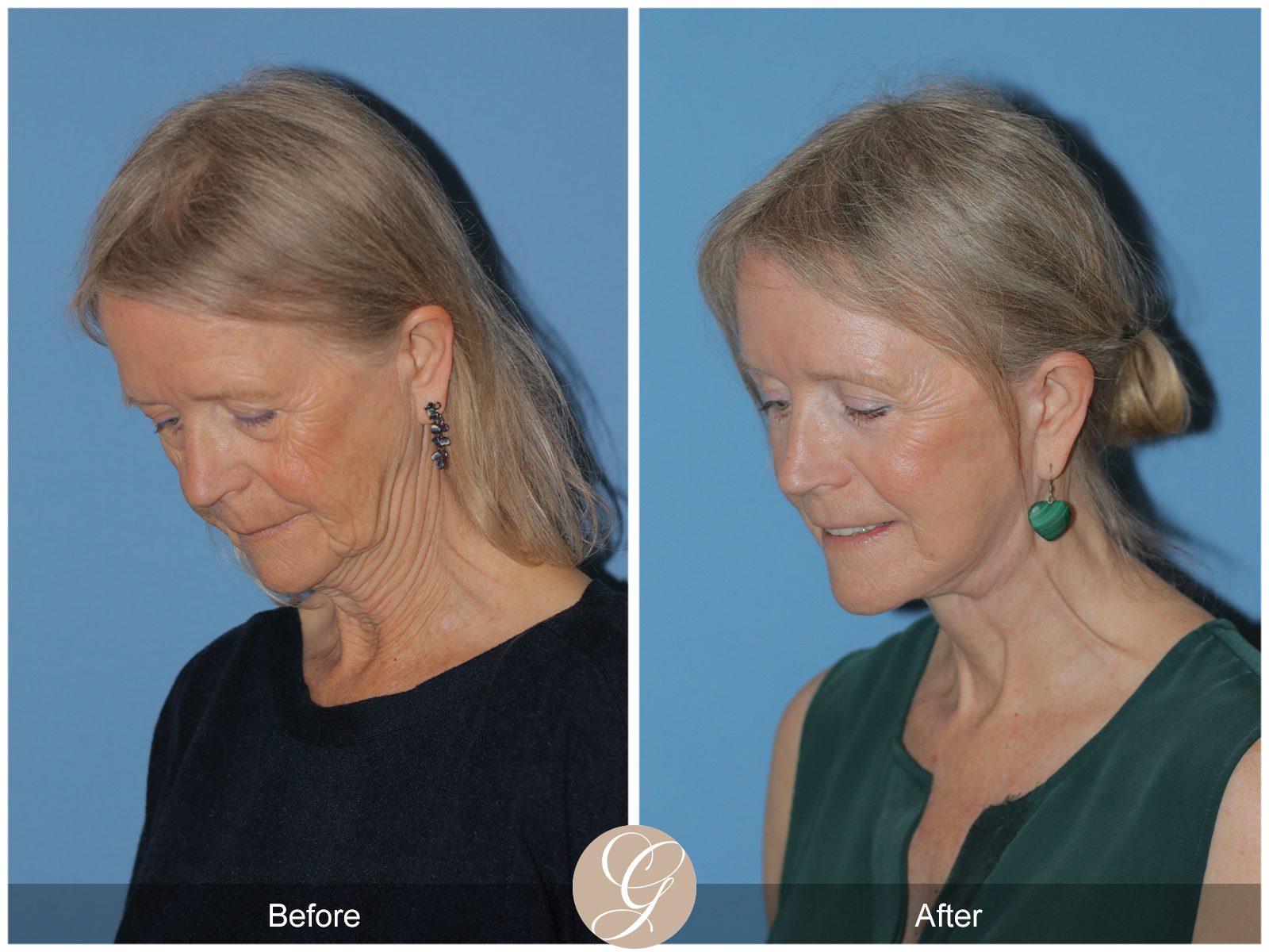 Preservation Deep Plane Facelift Case 42 Image