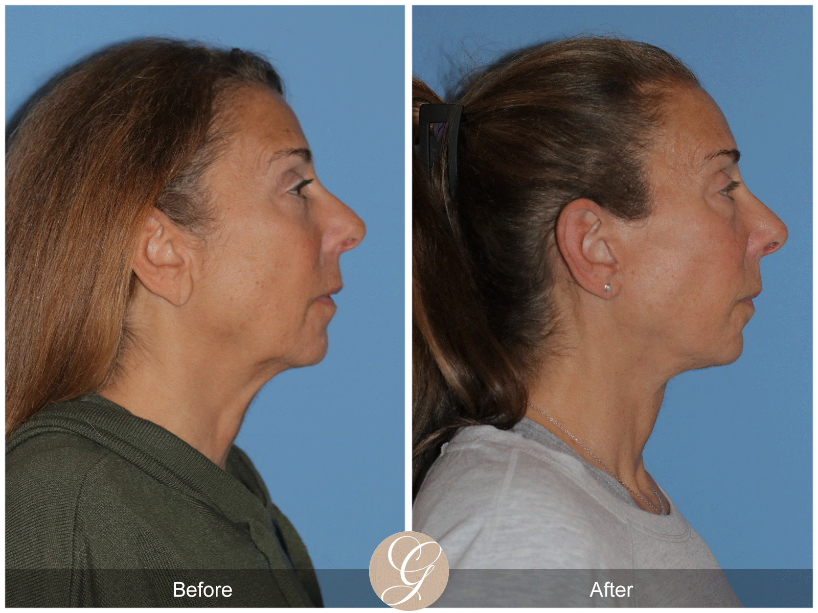 Preservation Deep Plane Facelift Case 43 Image