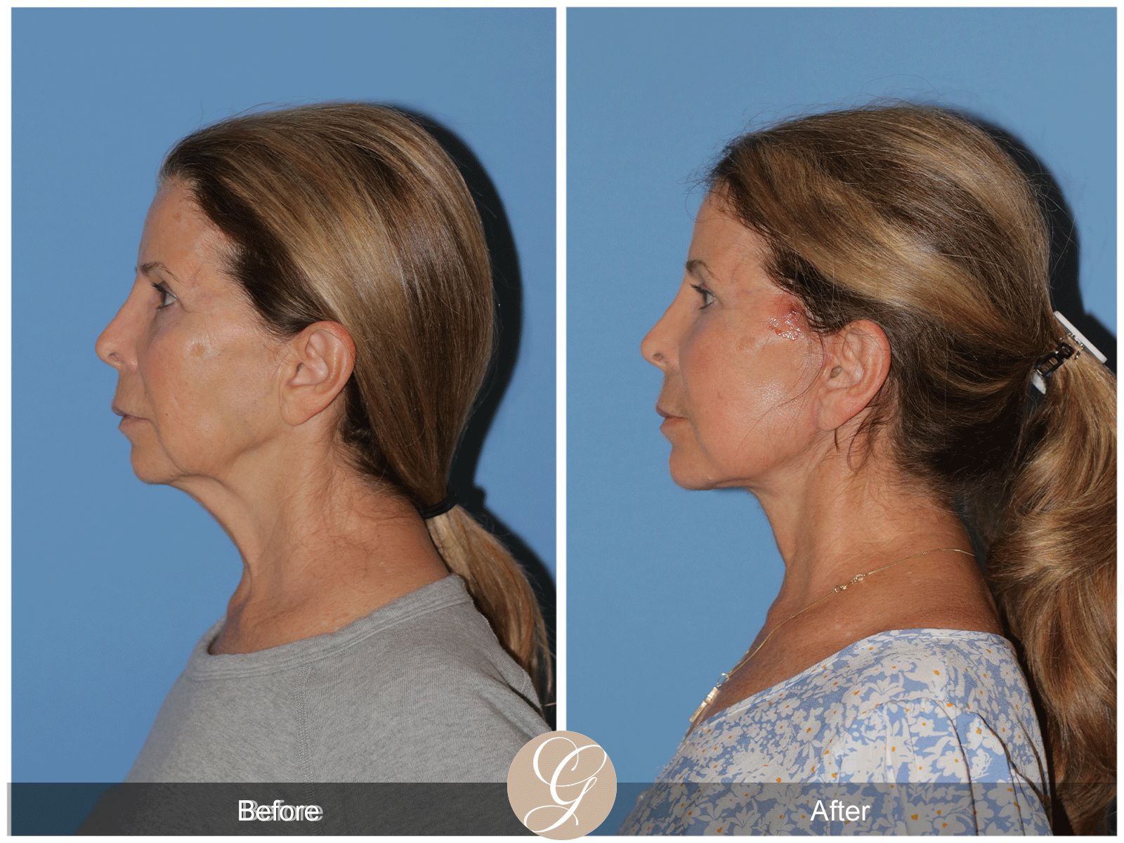 Preservation Deep Plane Facelift Case 44 Image