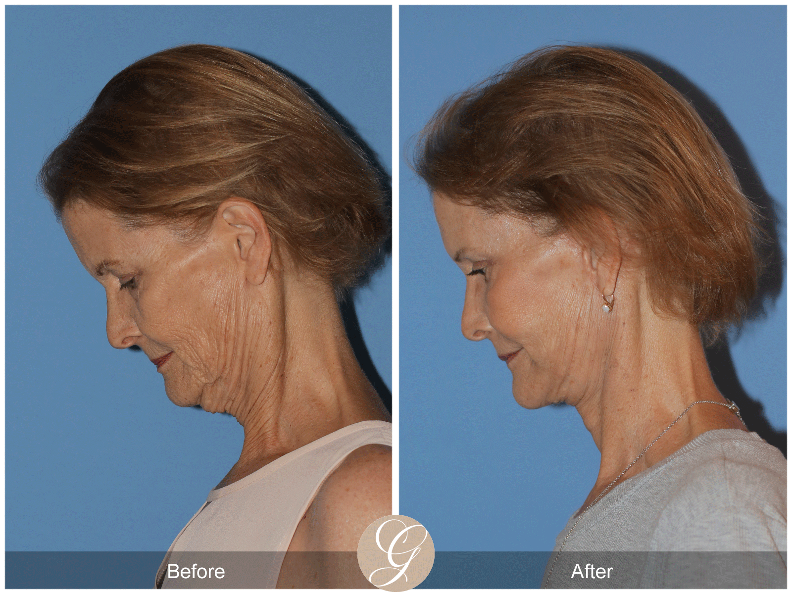 Deep Plane Facelift Case 36 Image