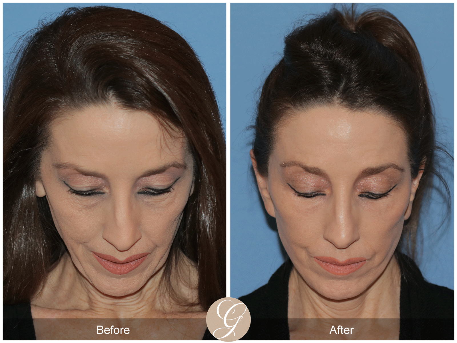 Deep Plane Facelift Case 38 Image