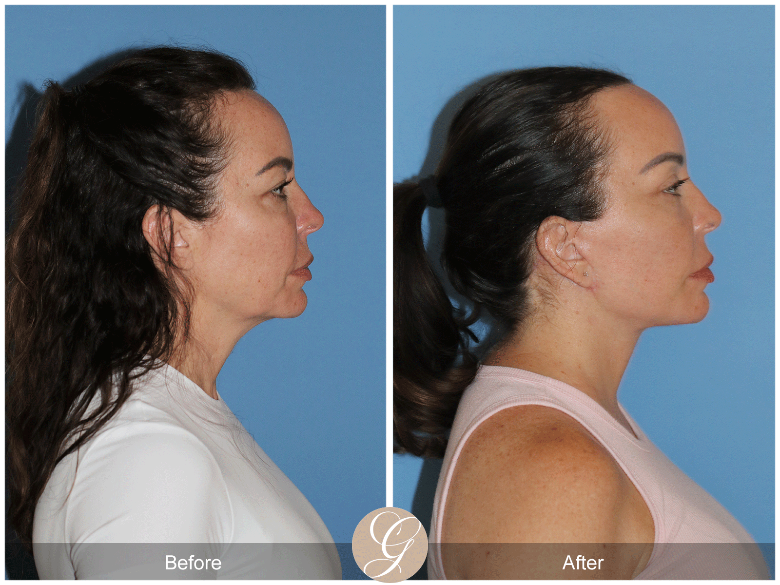 Preservation Deep Plane Facelift Case 46 Image