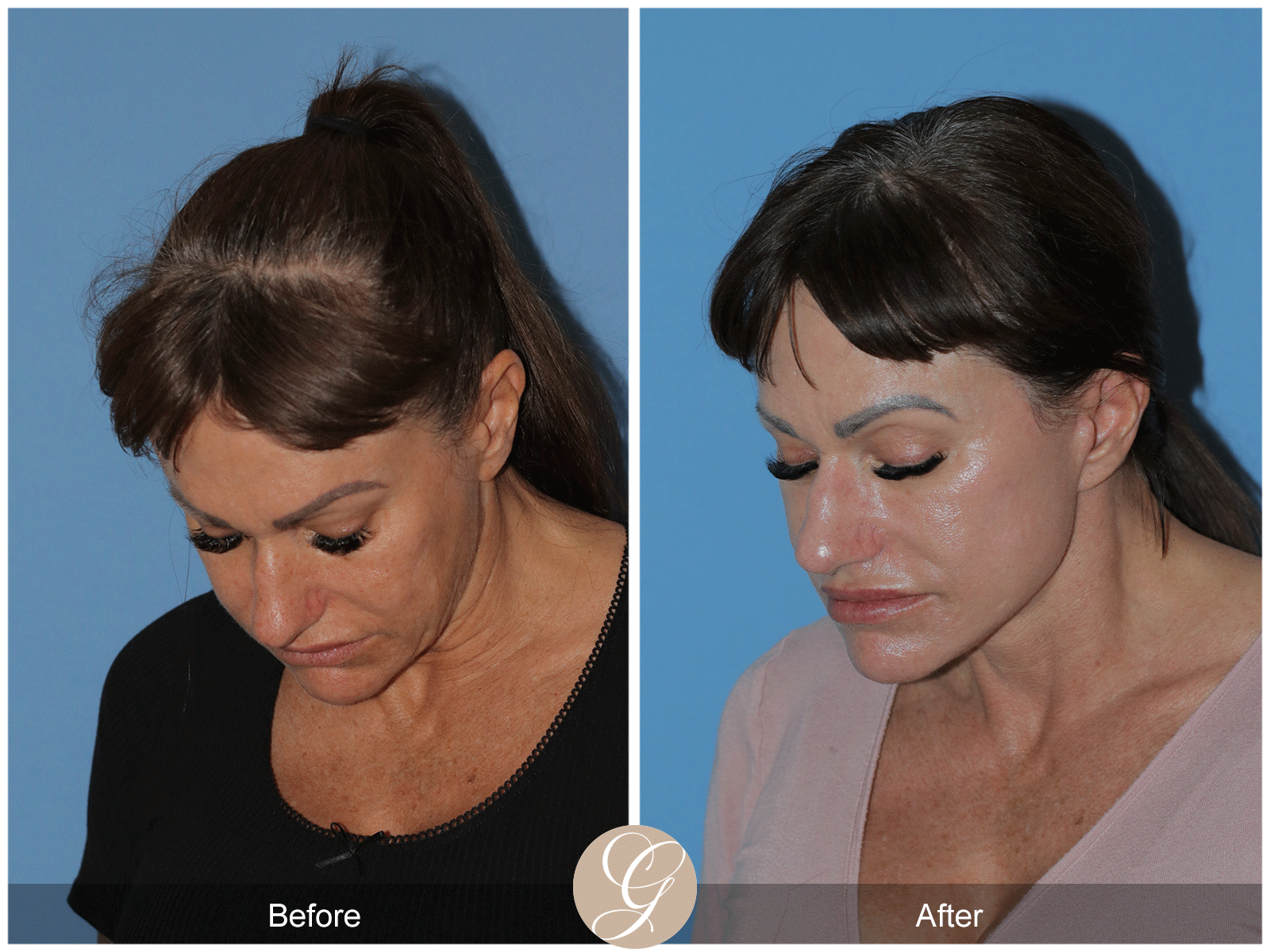 Preservation Deep Plane Facelift Case 47 Image