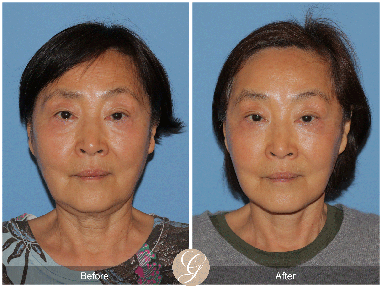 Deep Plane Facelift Case 45 Image