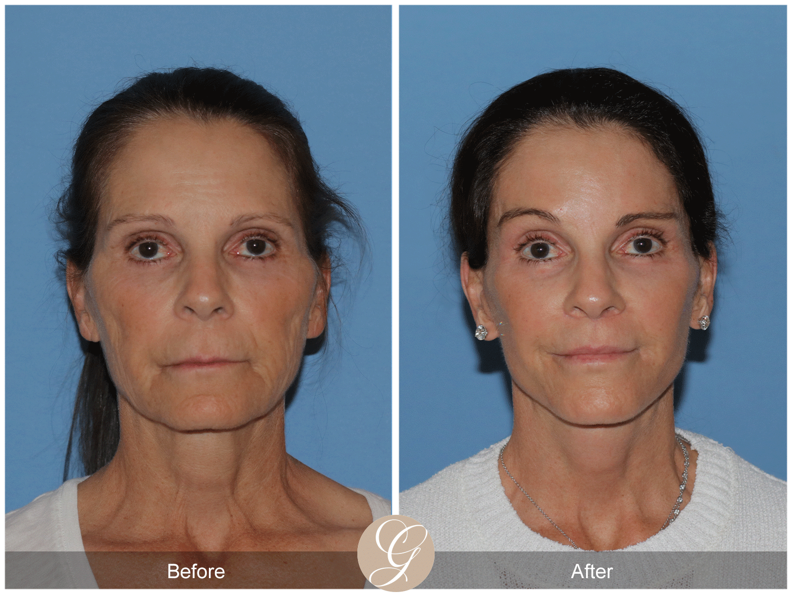 Deep Plane Facelift Case 46 Image