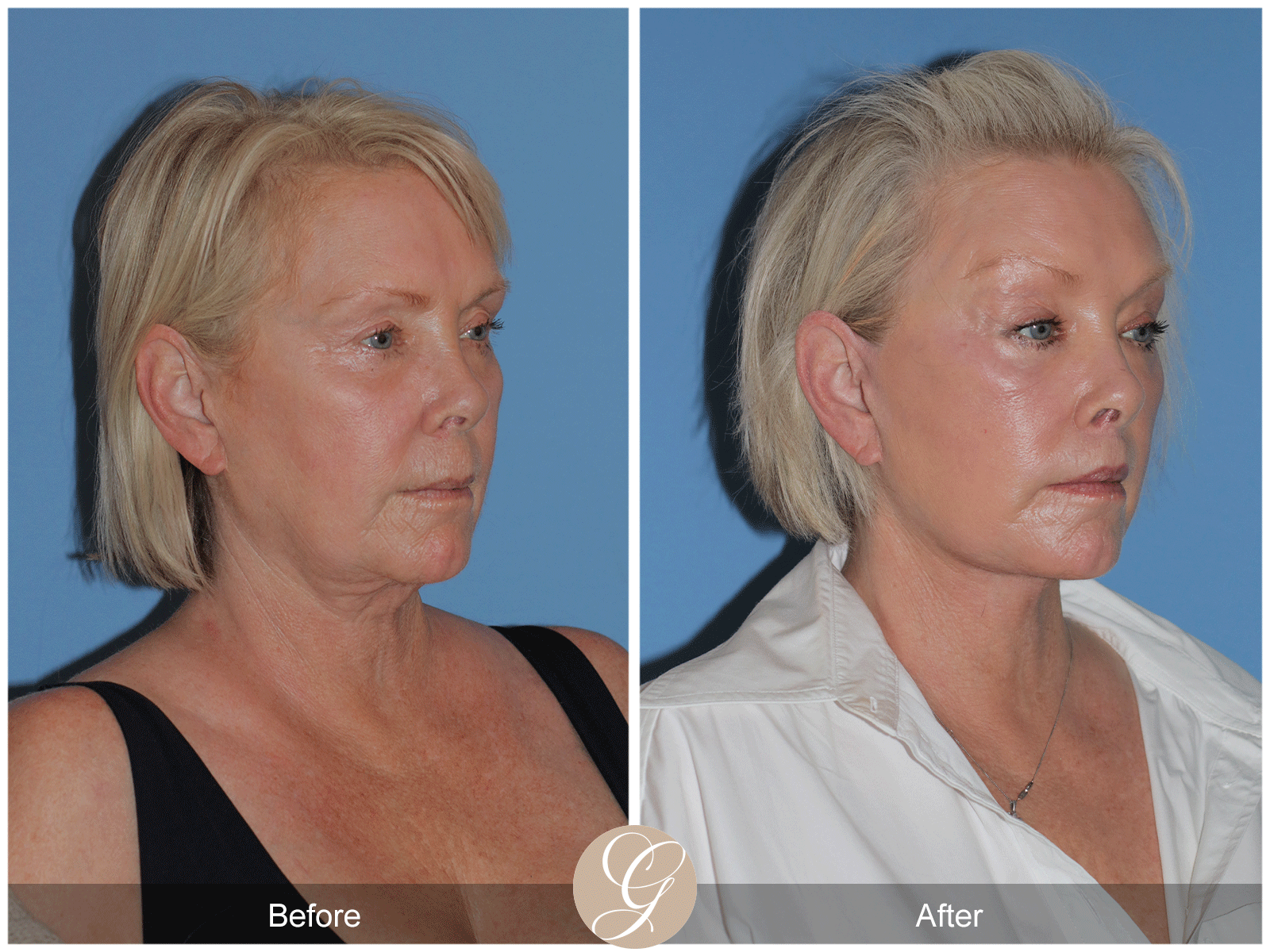 Preservation Deep Plane Facelift Case 48 Image