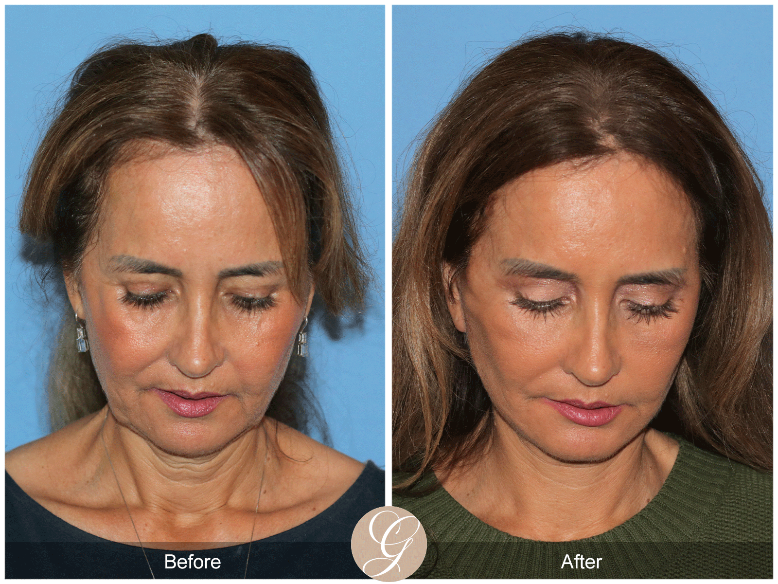 Preservation Deep Plane Facelift Case 49 Image