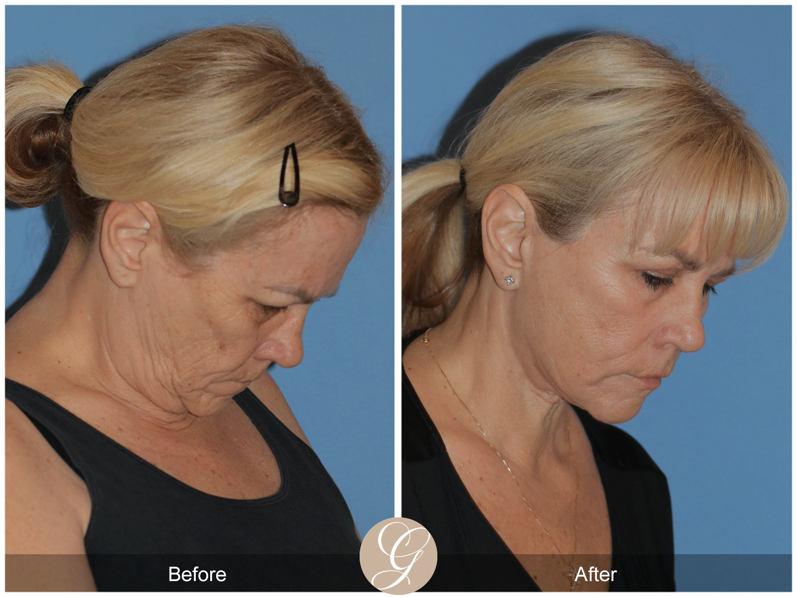 Deep Plane Facelift Case 38 Image