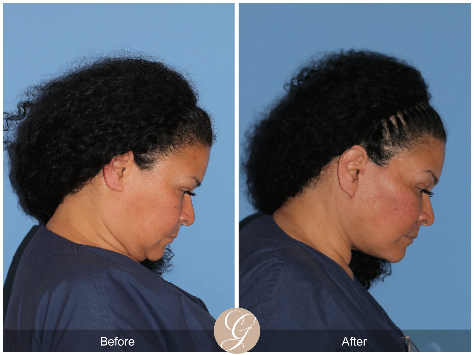 Deep Plane Facelift Case 40 Image