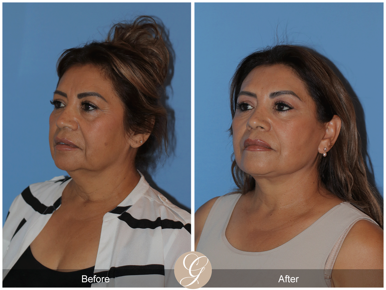 Preservation Deep Plane Facelift Case 41 Image