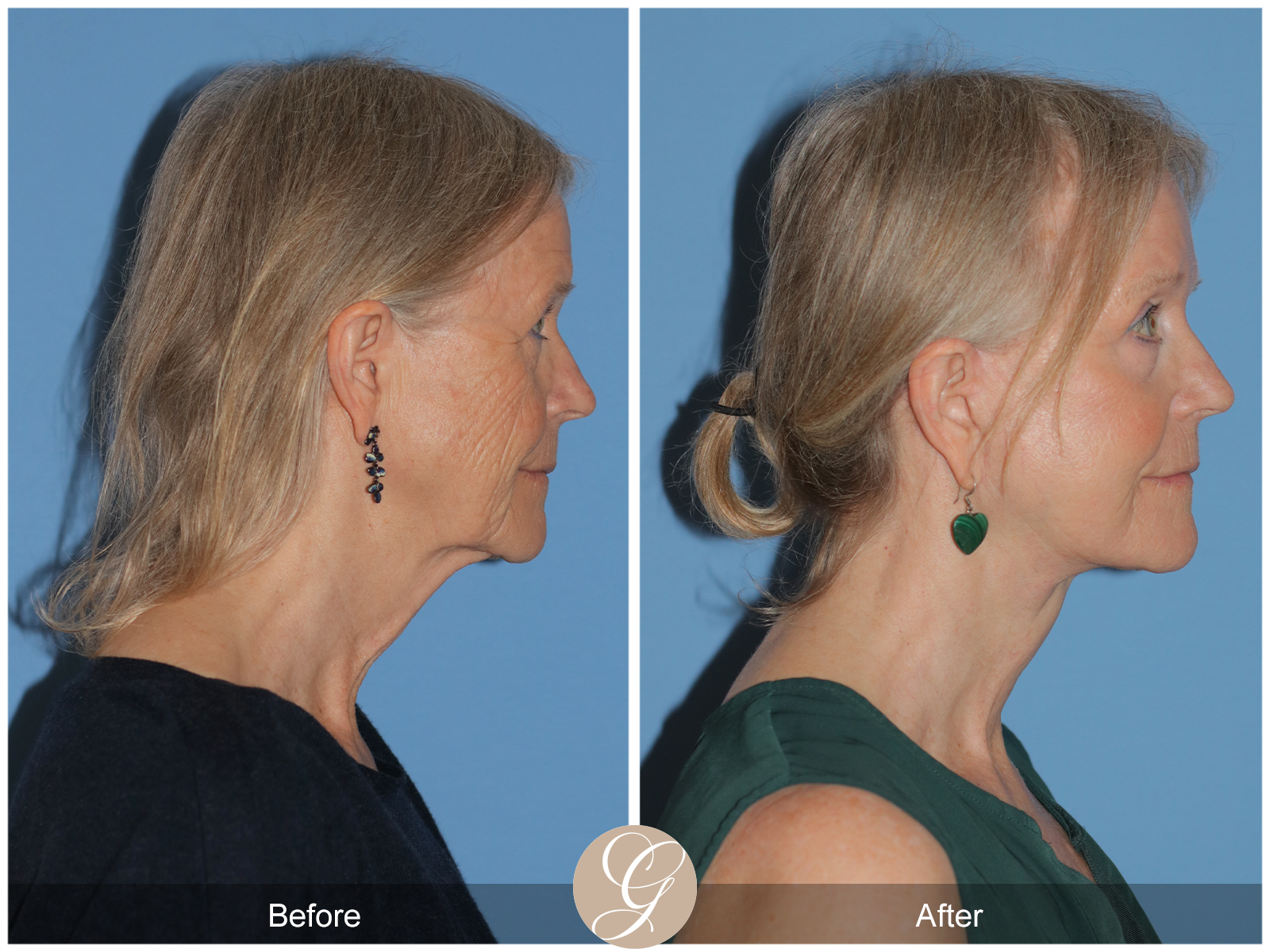 Preservation Deep Plane Facelift Case 42 Image