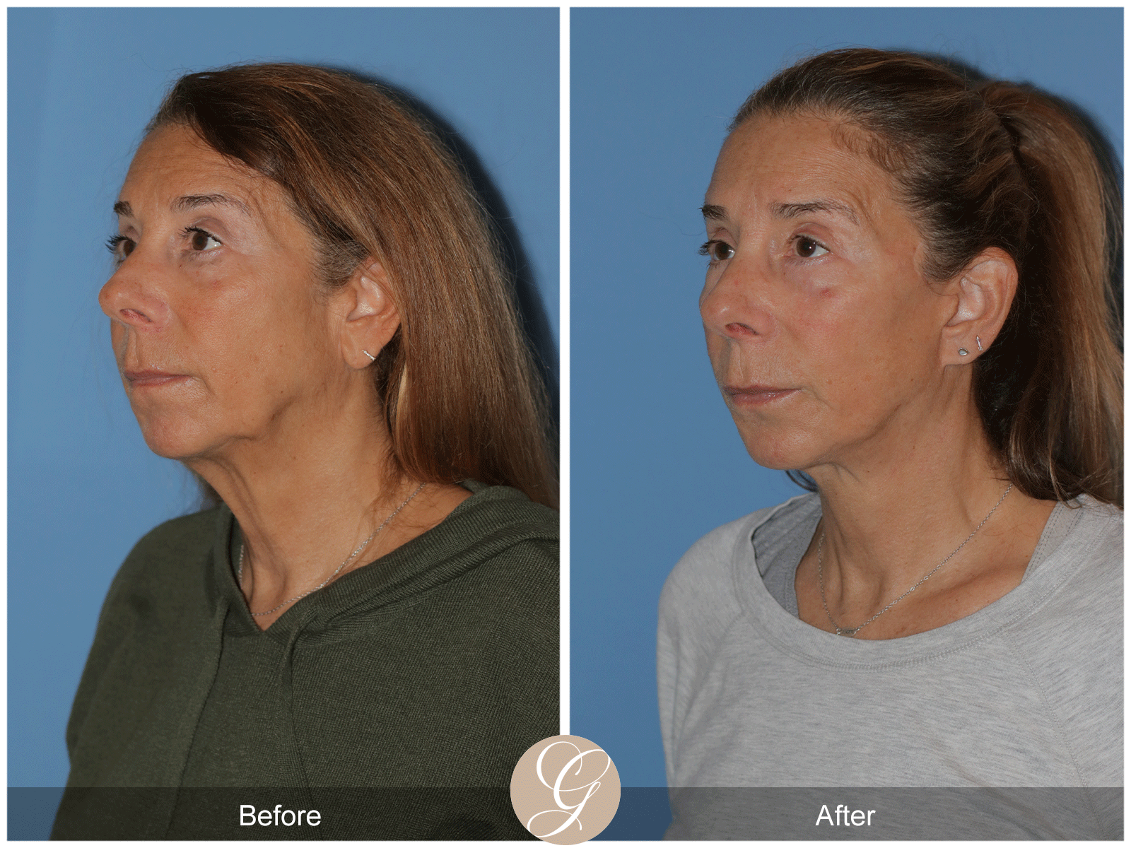 Preservation Deep Plane Facelift Case 43 Image