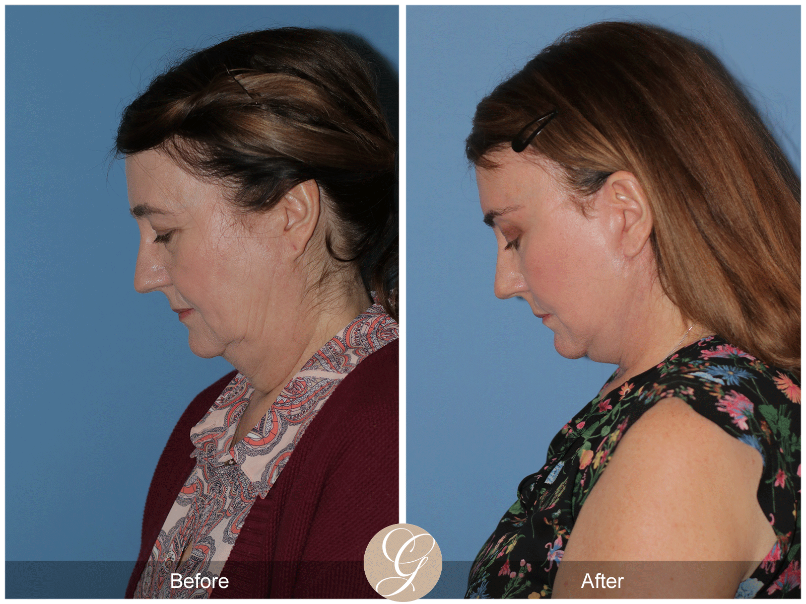 Deep Plane Facelift Case 43 Image