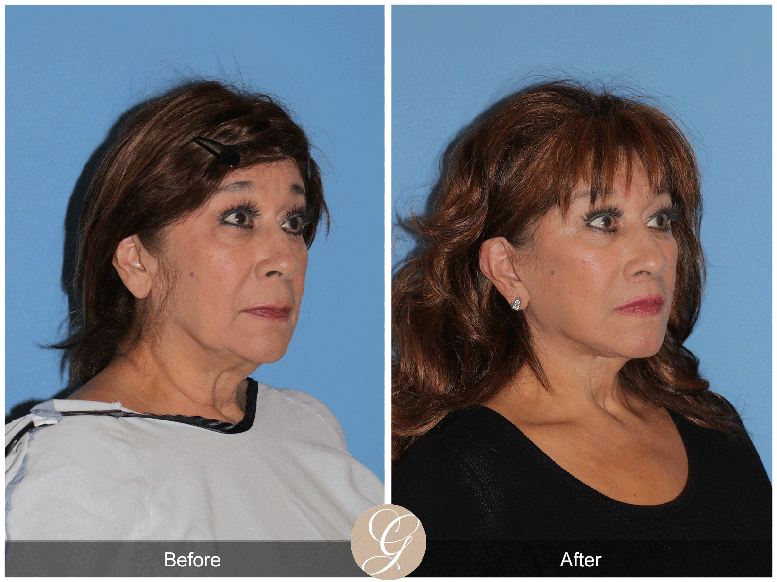 Deep Plane Facelift Case 44 Image