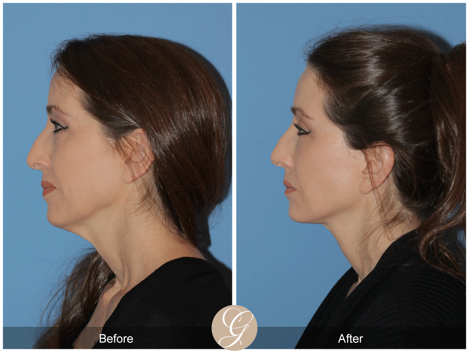 Deep Plane Facelift Case 38 Image