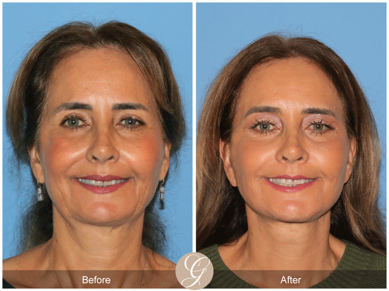 Preservation Deep Plane Facelift Case 49 Image