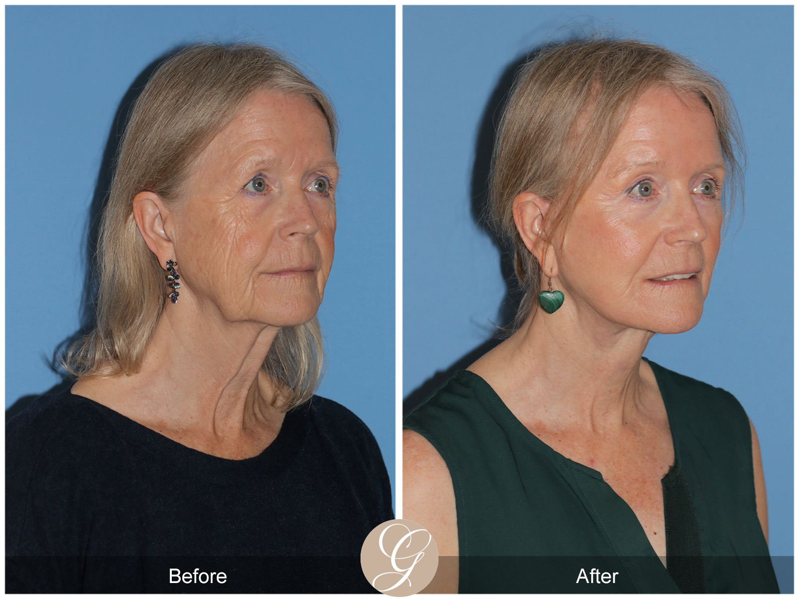 Preservation Deep Plane Facelift Case 42 Image