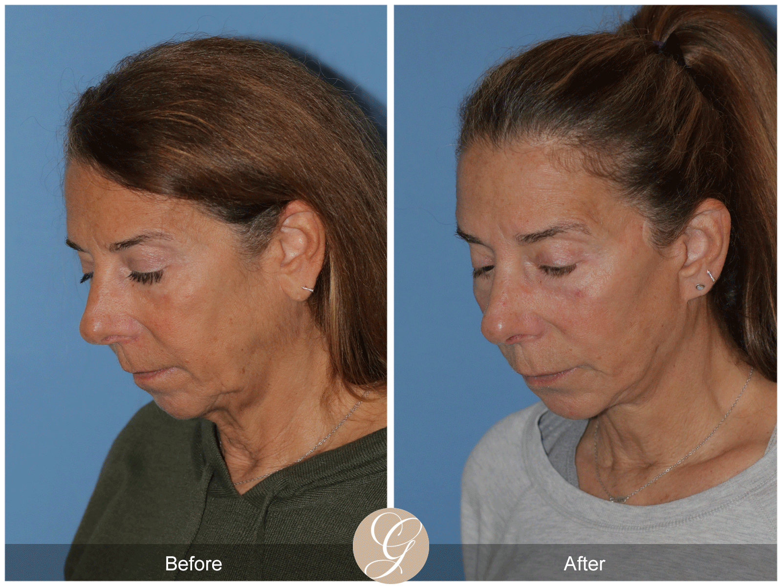 Preservation Deep Plane Facelift Case 43 Image