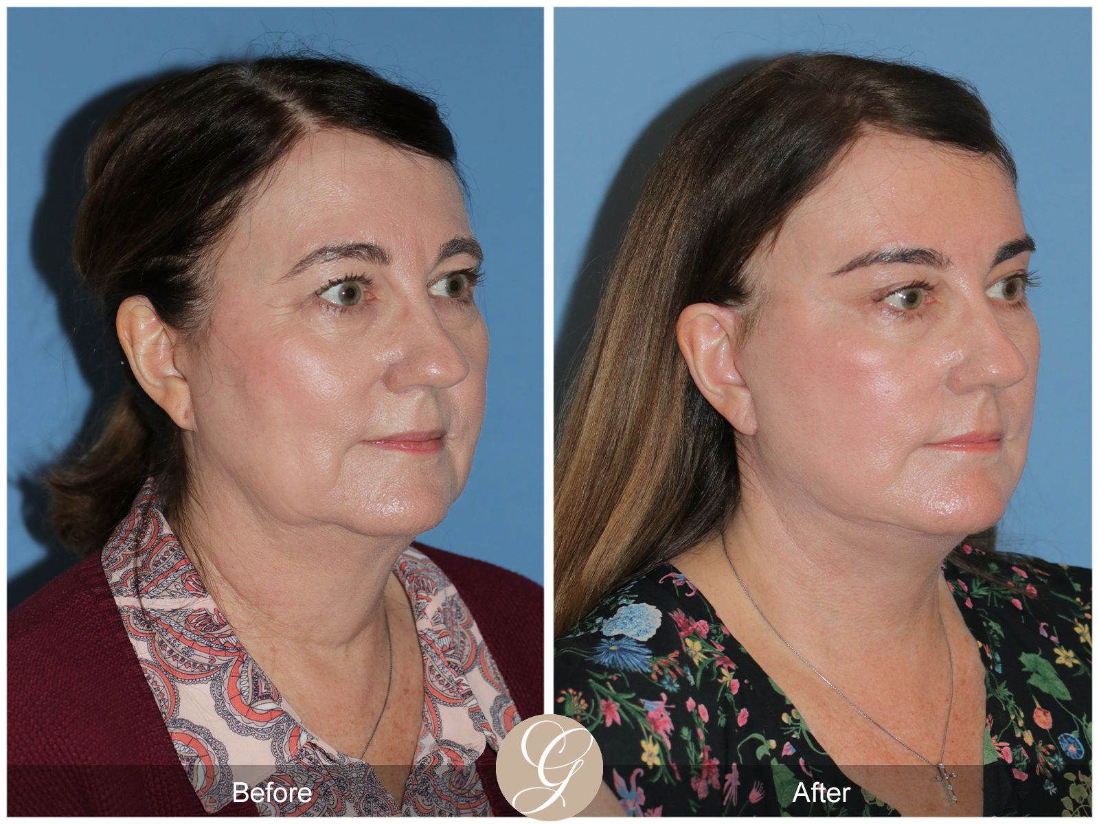 Deep Plane Facelift Case 43 Image