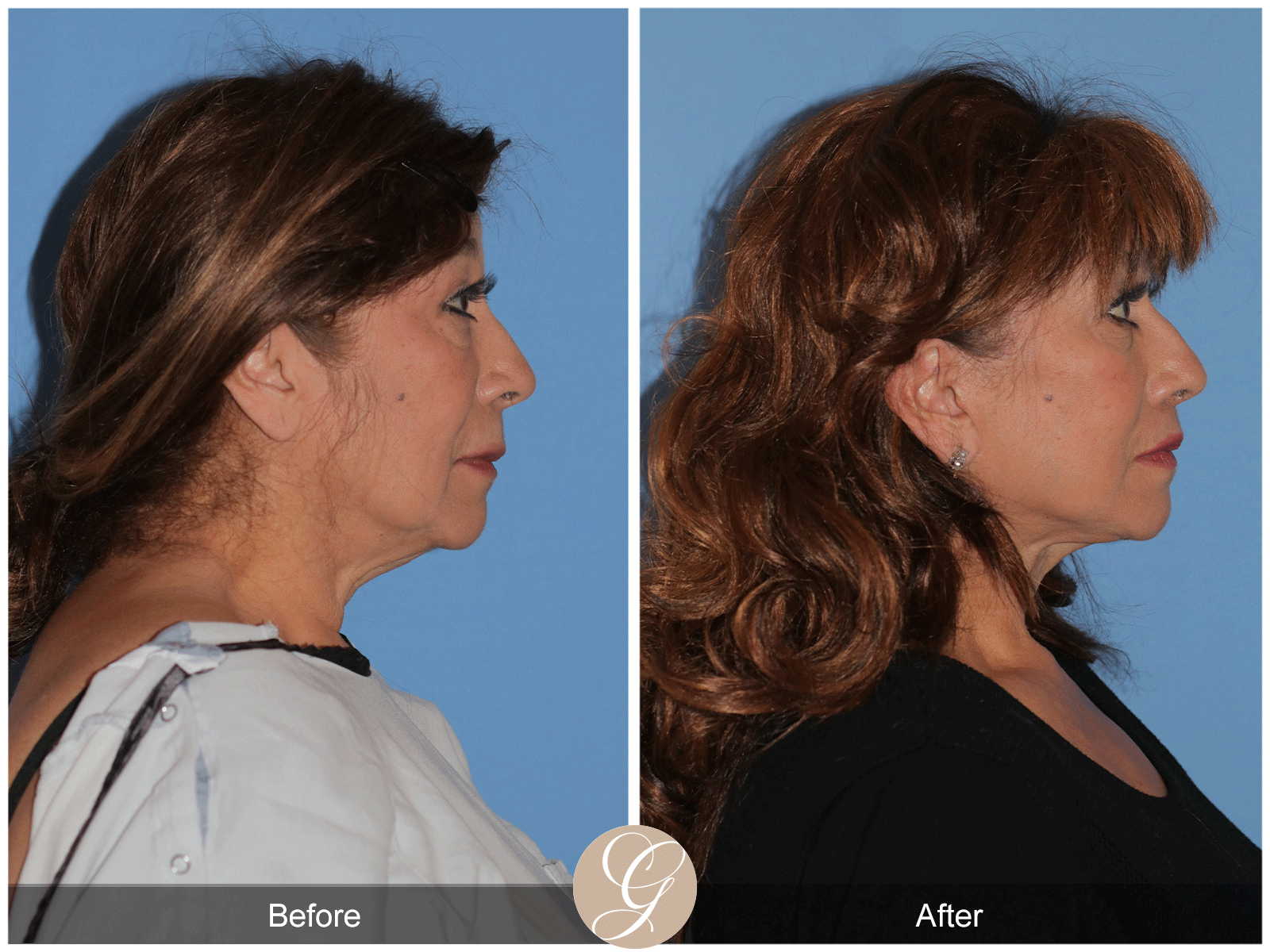 Deep Plane Facelift Case 44 Image