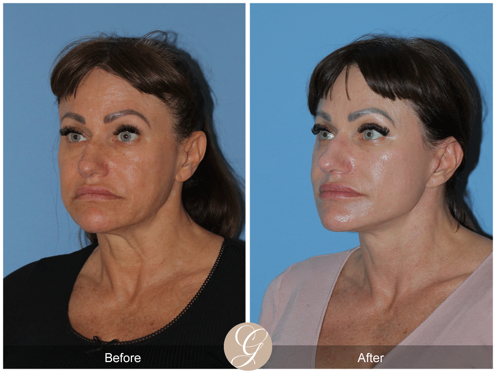 Preservation Deep Plane Facelift Case 47 Image