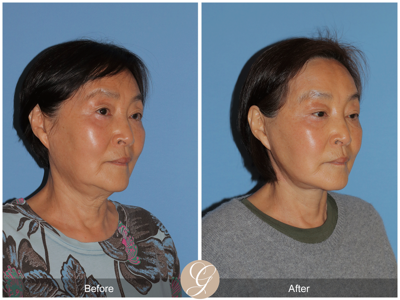 Deep Plane Facelift Case 45 Image