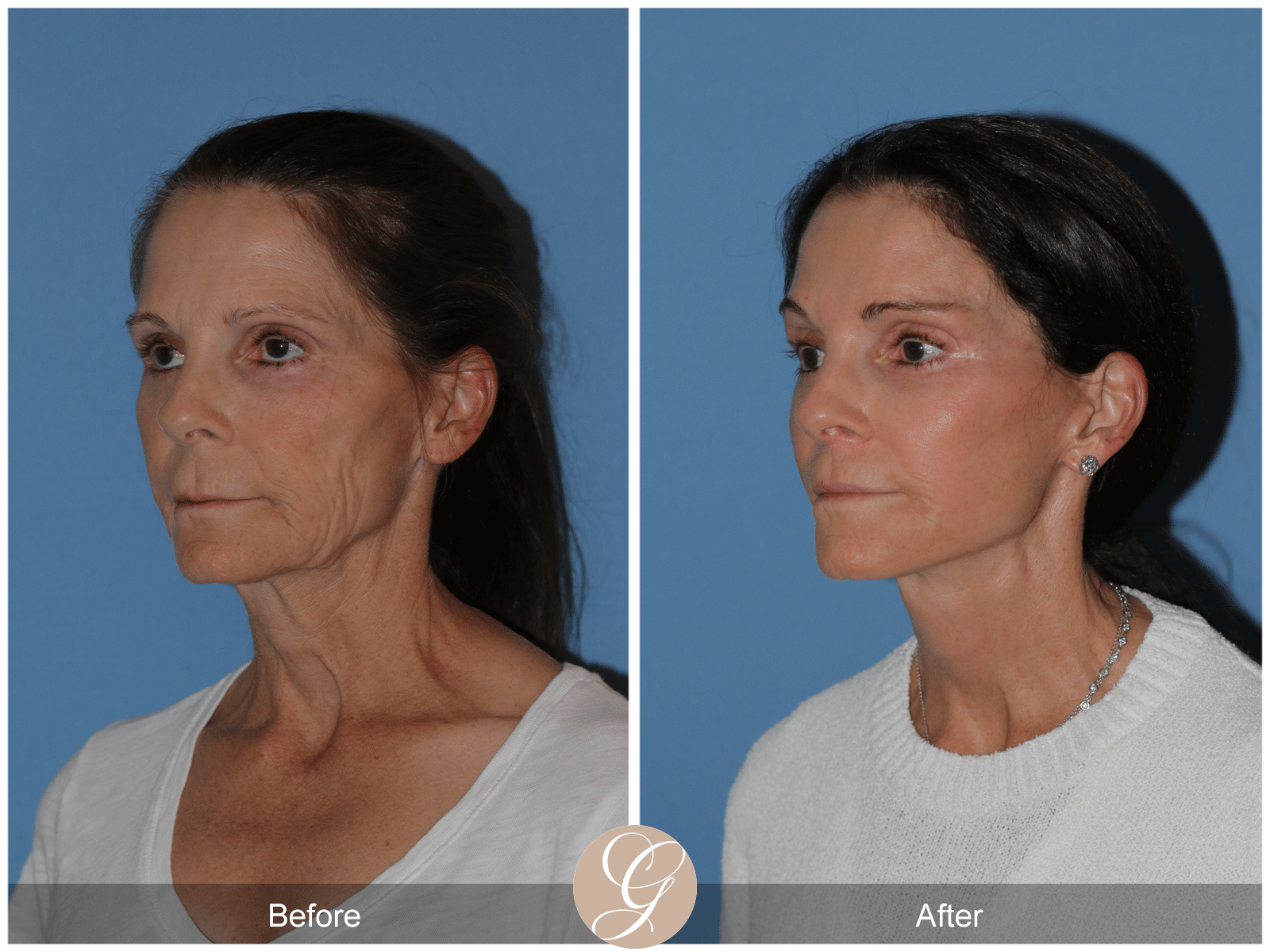 Deep Plane Facelift Case 46 Image