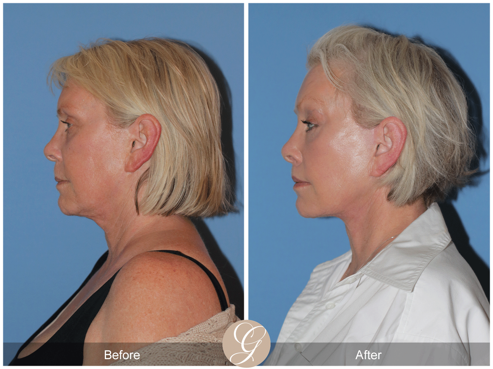 Preservation Deep Plane Facelift Case 48 Image