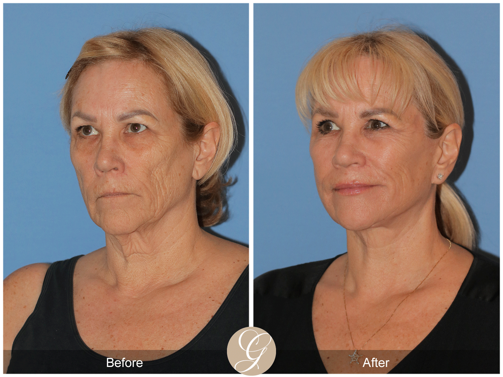 Deep Plane Facelift Case 38 Image
