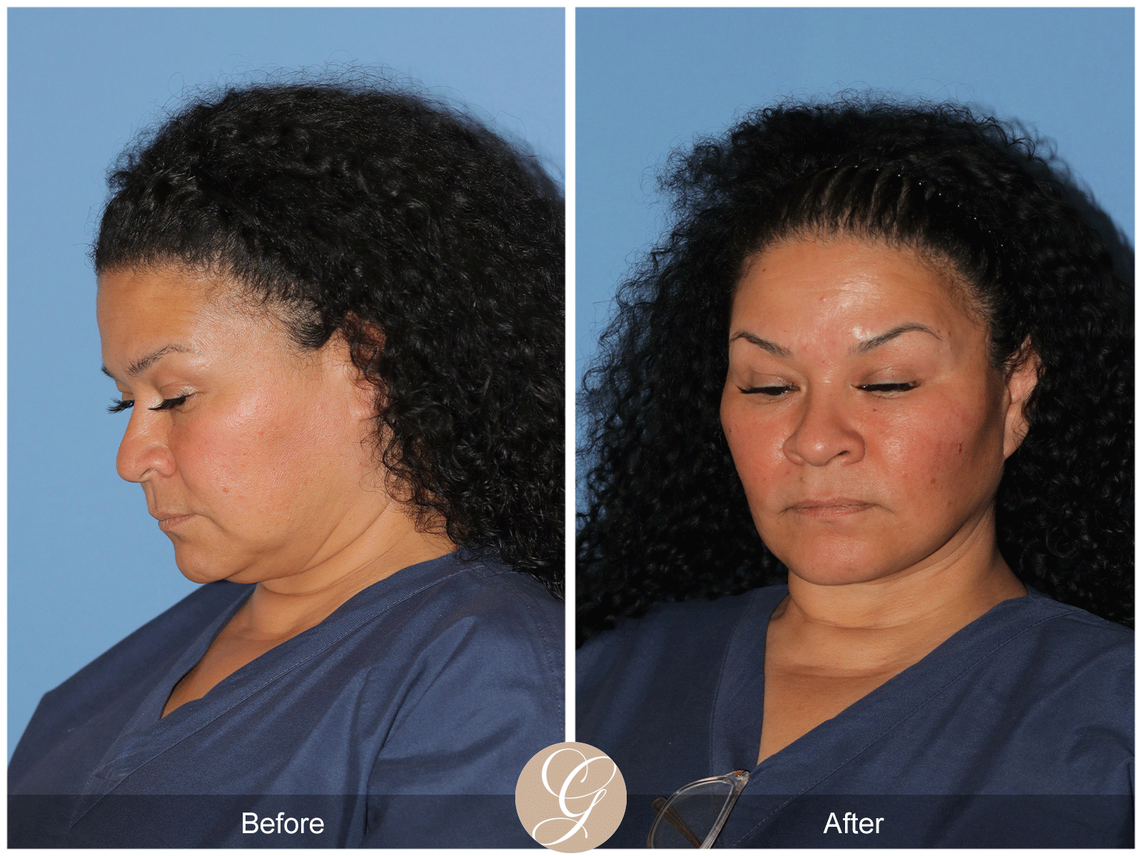 Deep Plane Facelift Case 40 Image