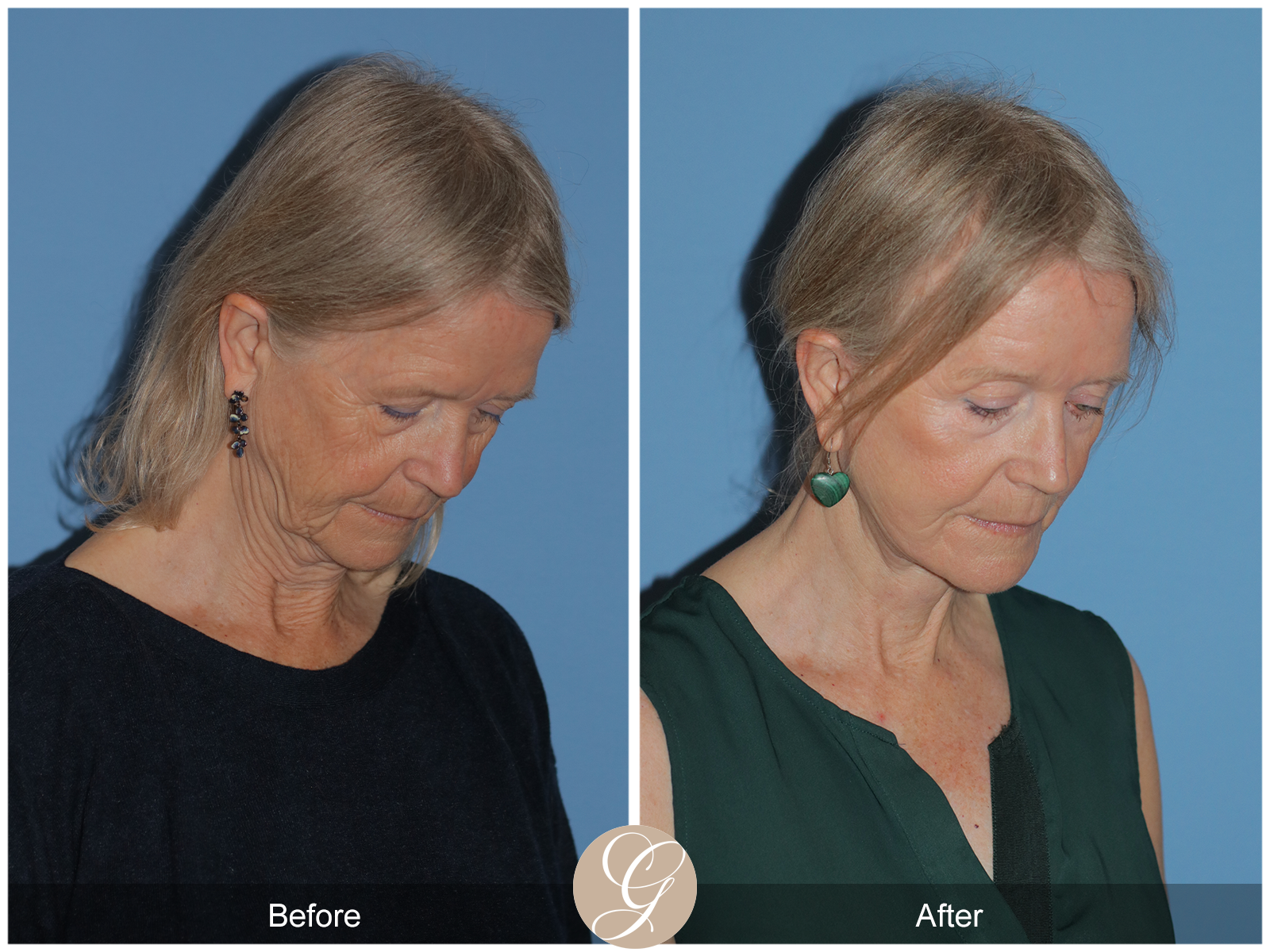 Preservation Deep Plane Facelift Case 42 Image