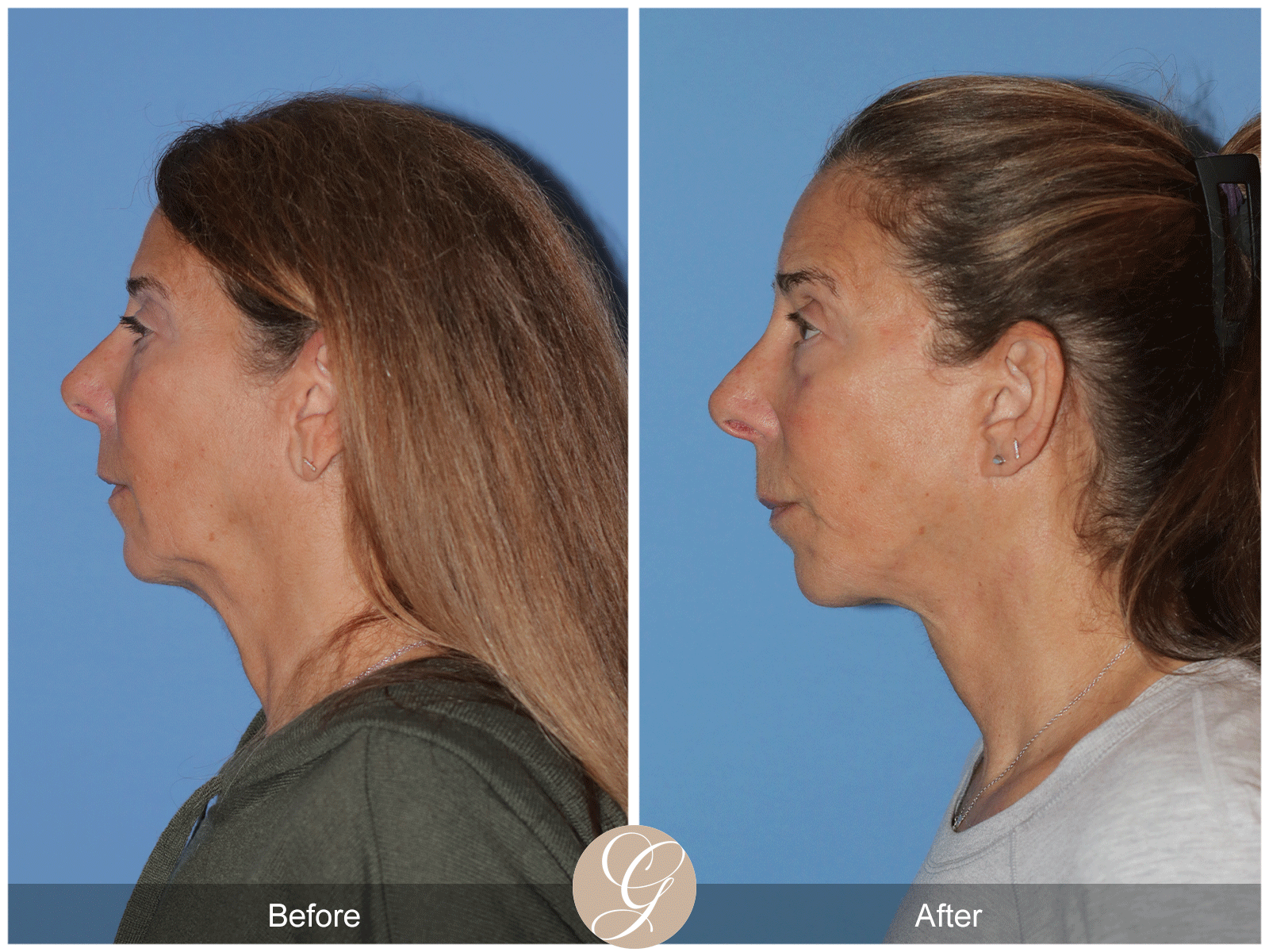 Preservation Deep Plane Facelift Case 43 Image