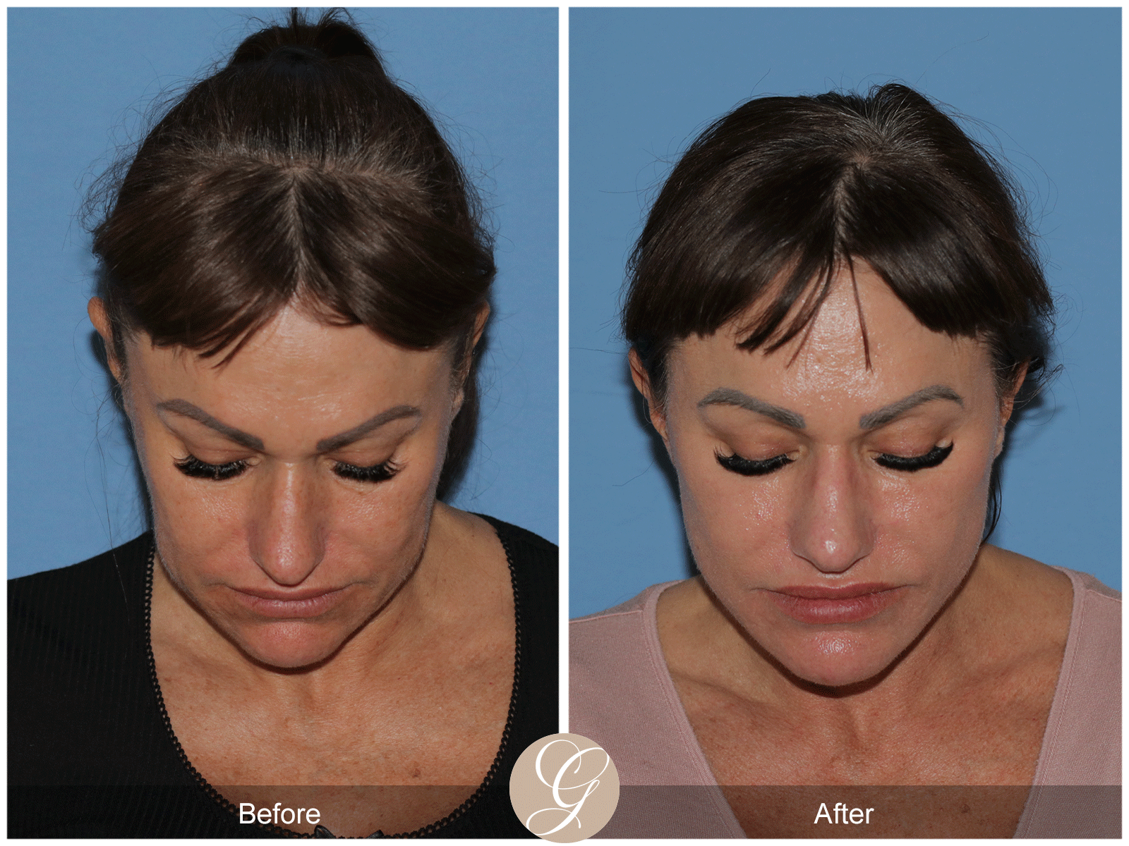 Preservation Deep Plane Facelift Case 47 Image