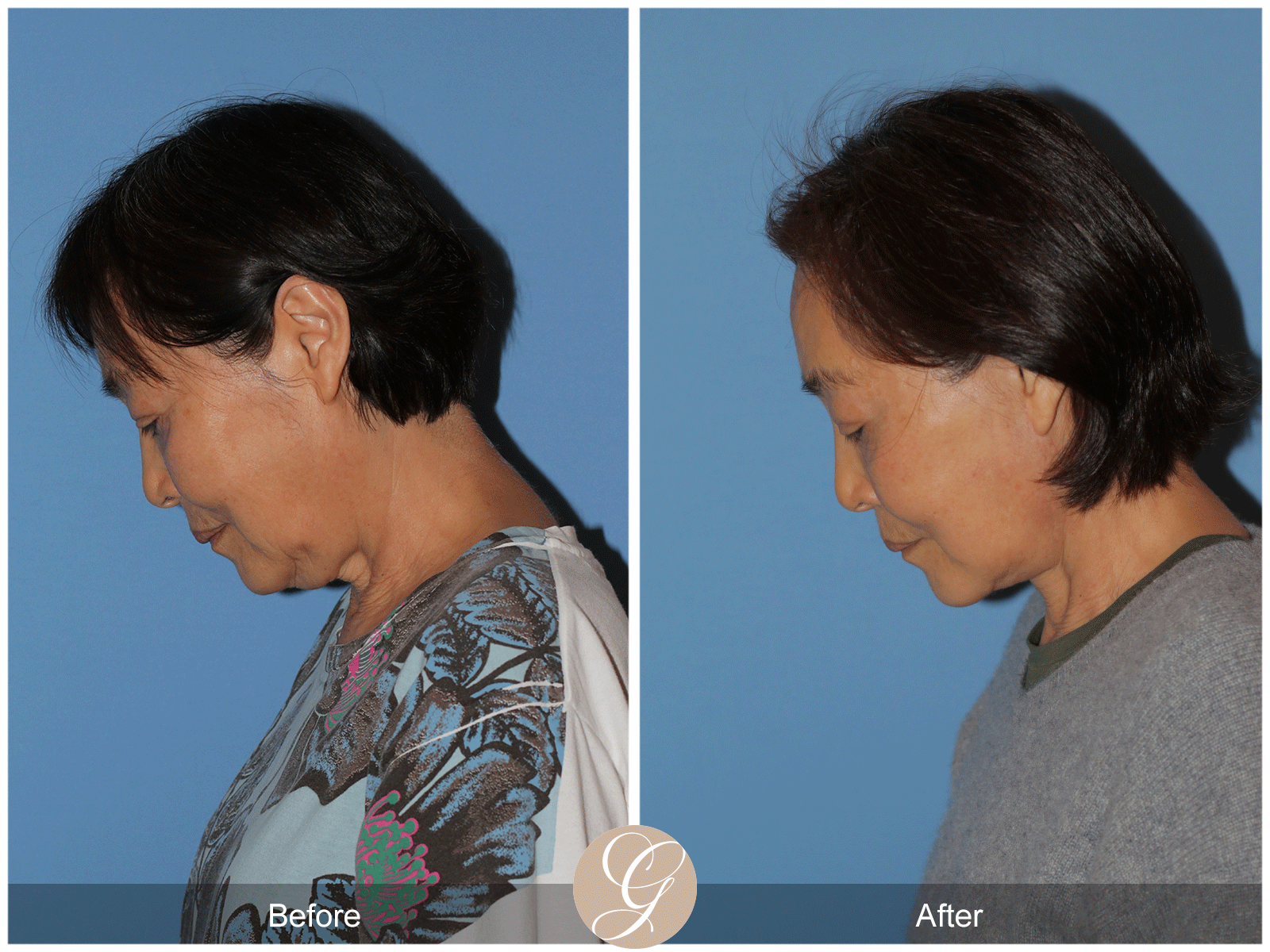 Deep Plane Facelift Case 45 Image