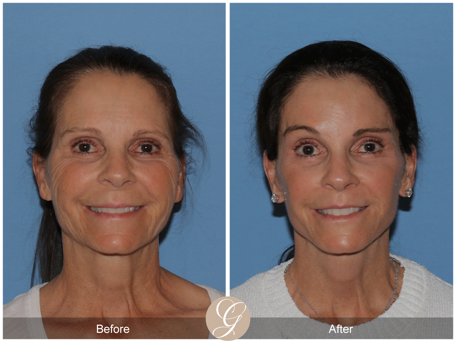 Deep Plane Facelift Case 46 Image