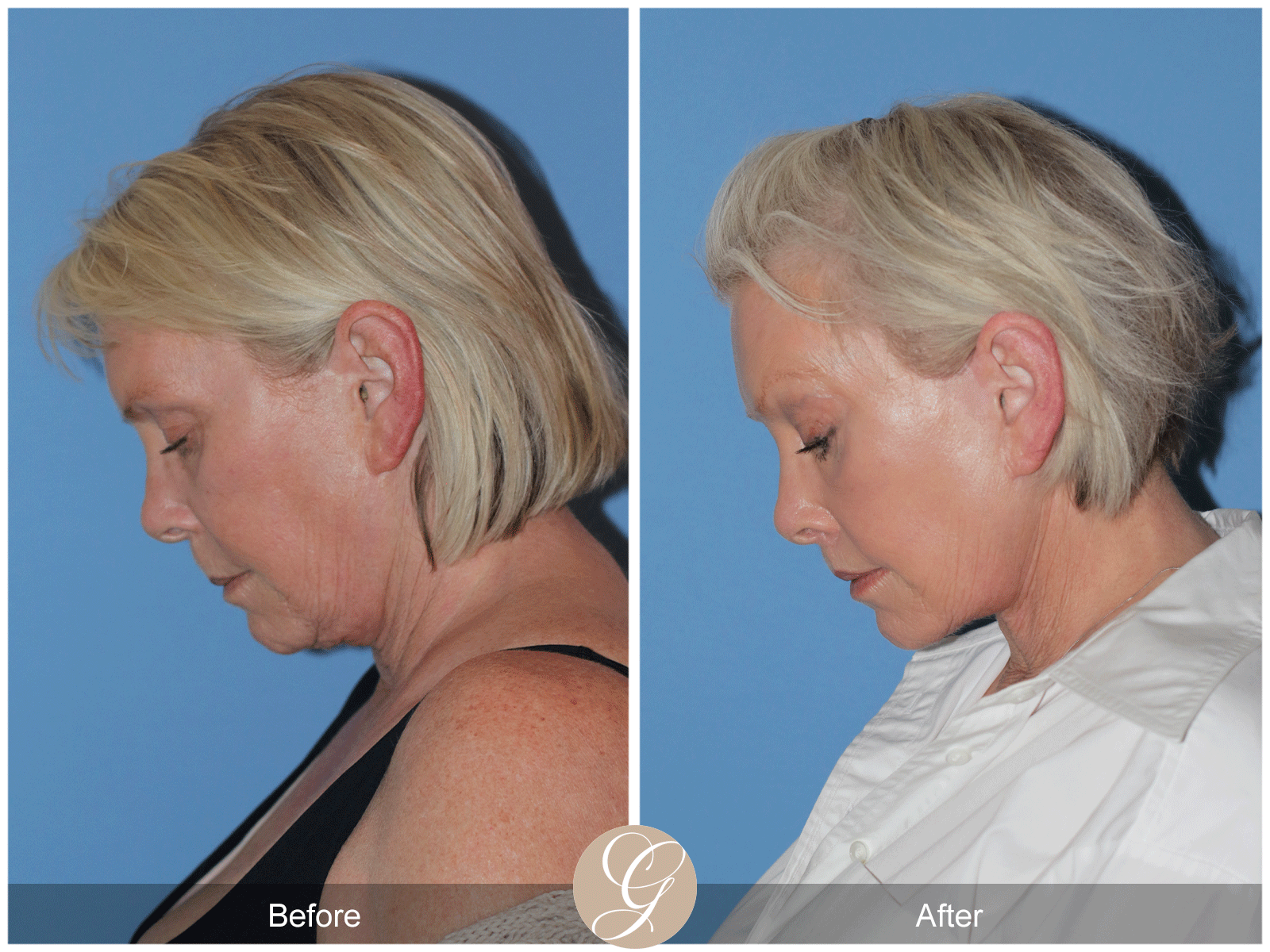 Preservation Deep Plane Facelift Case 48 Image