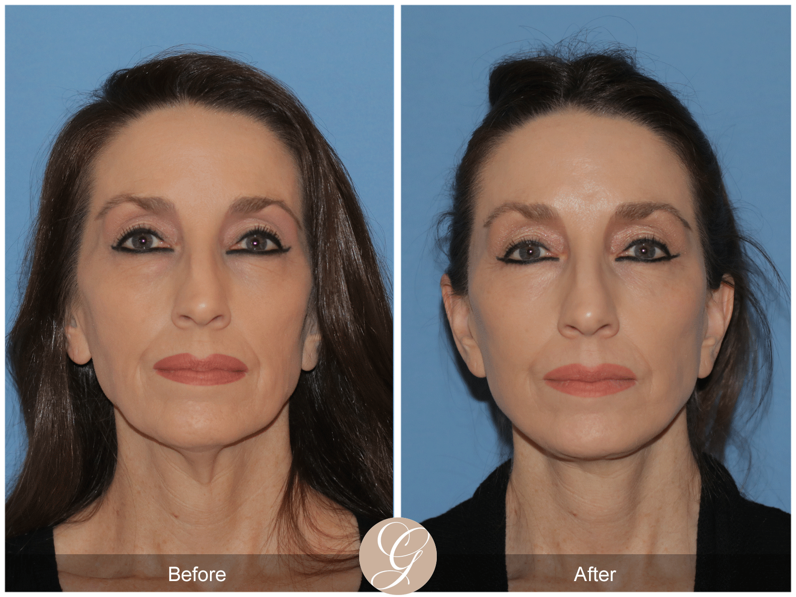 Deep Plane Facelift Case 38 Image