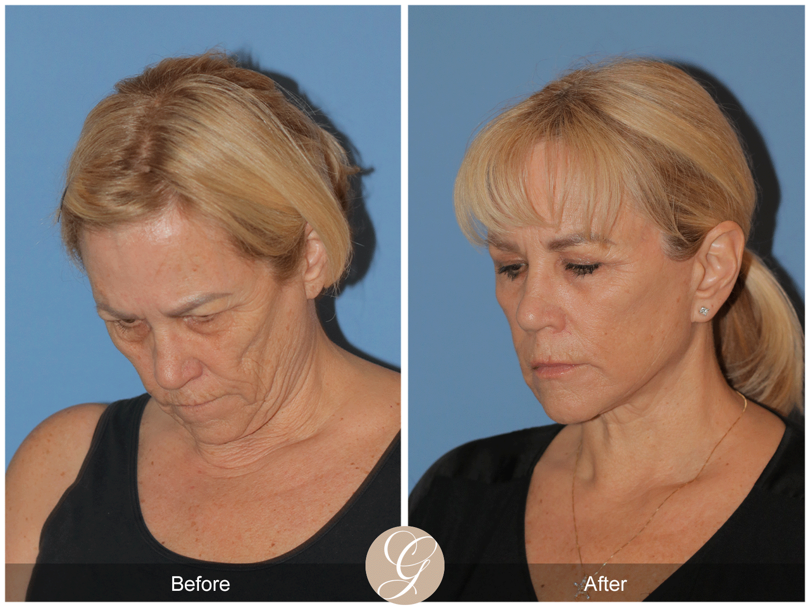 Deep Plane Facelift Case 38 Image