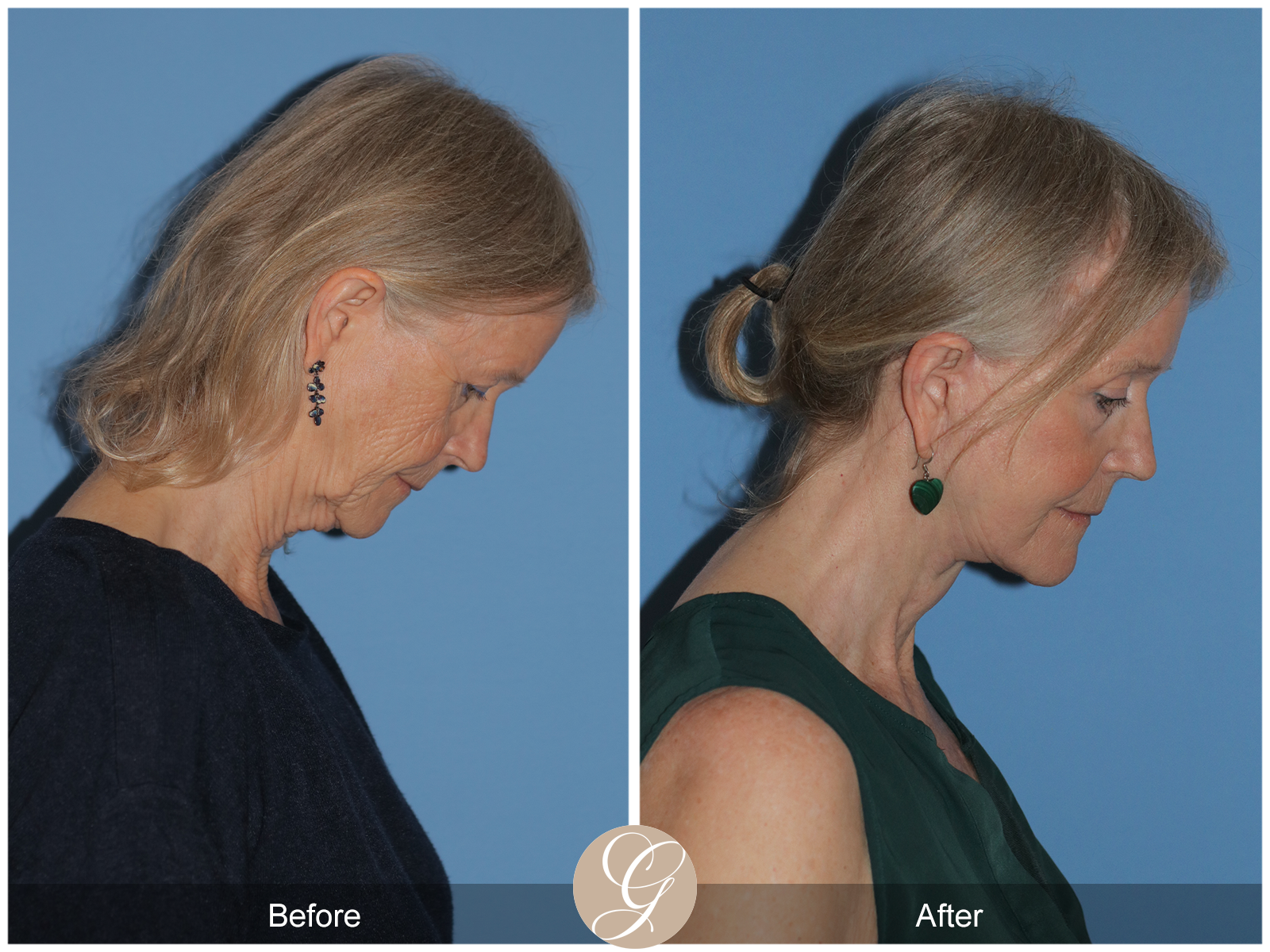 Preservation Deep Plane Facelift Case 42 Image