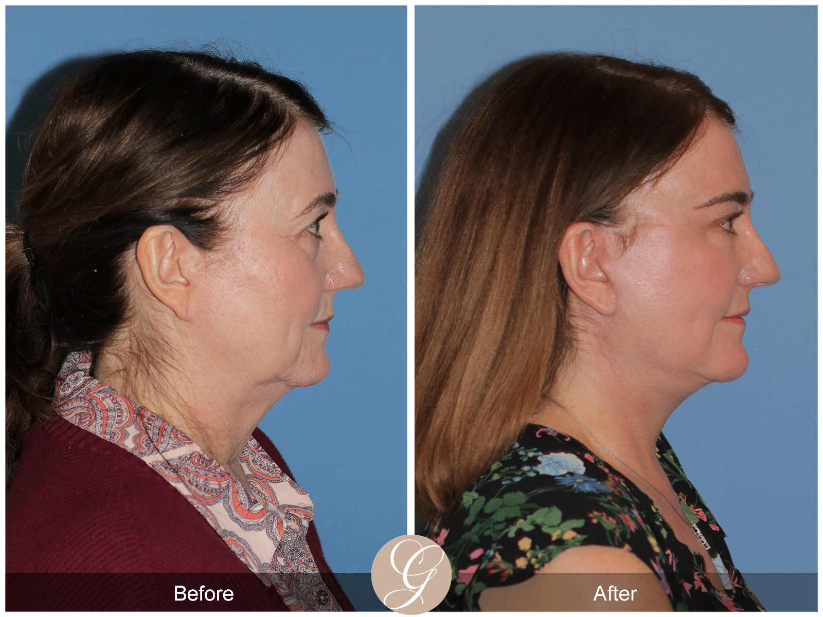 Deep Plane Facelift Case 43 Image