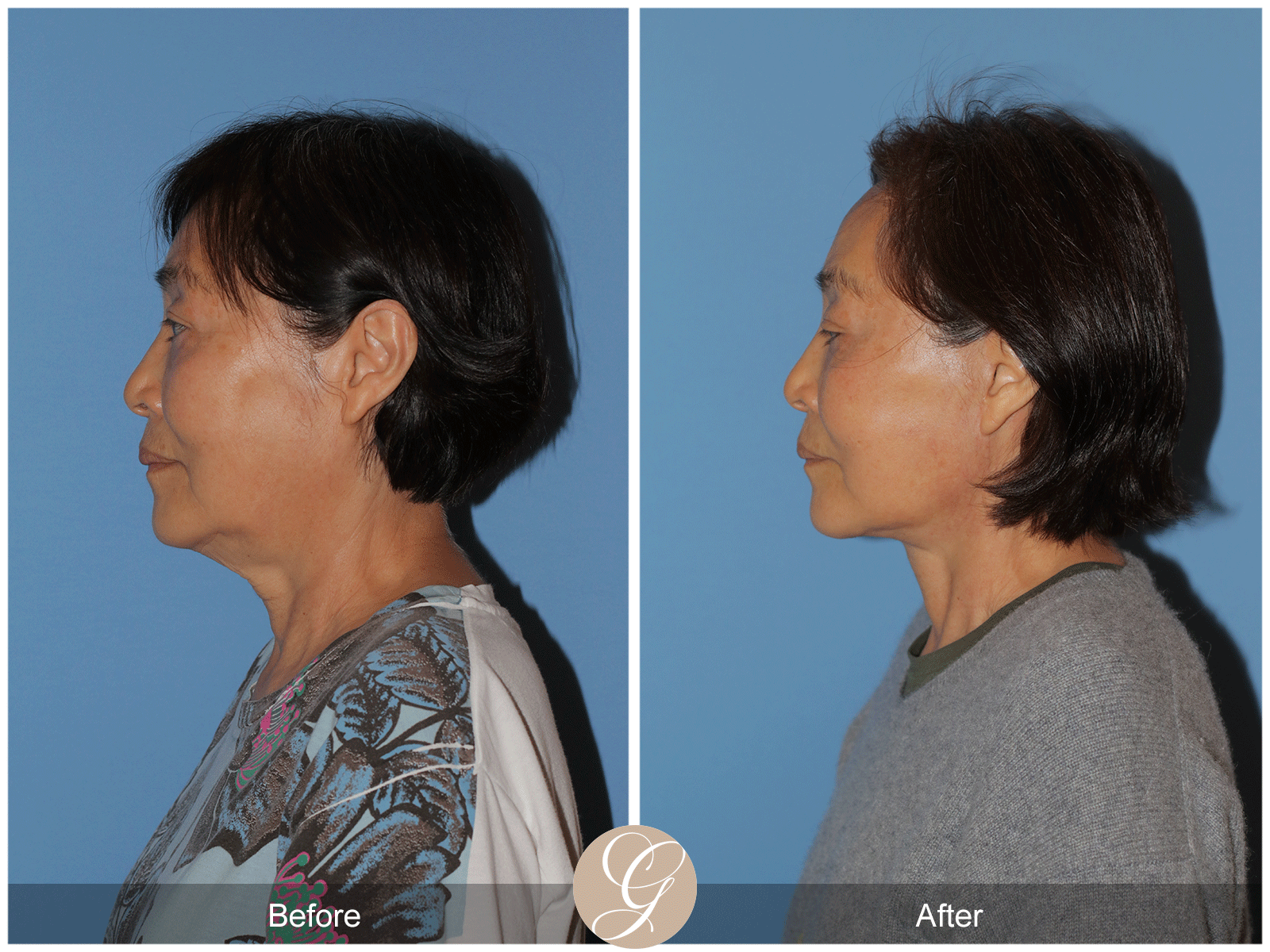 Deep Plane Facelift Case 45 Image