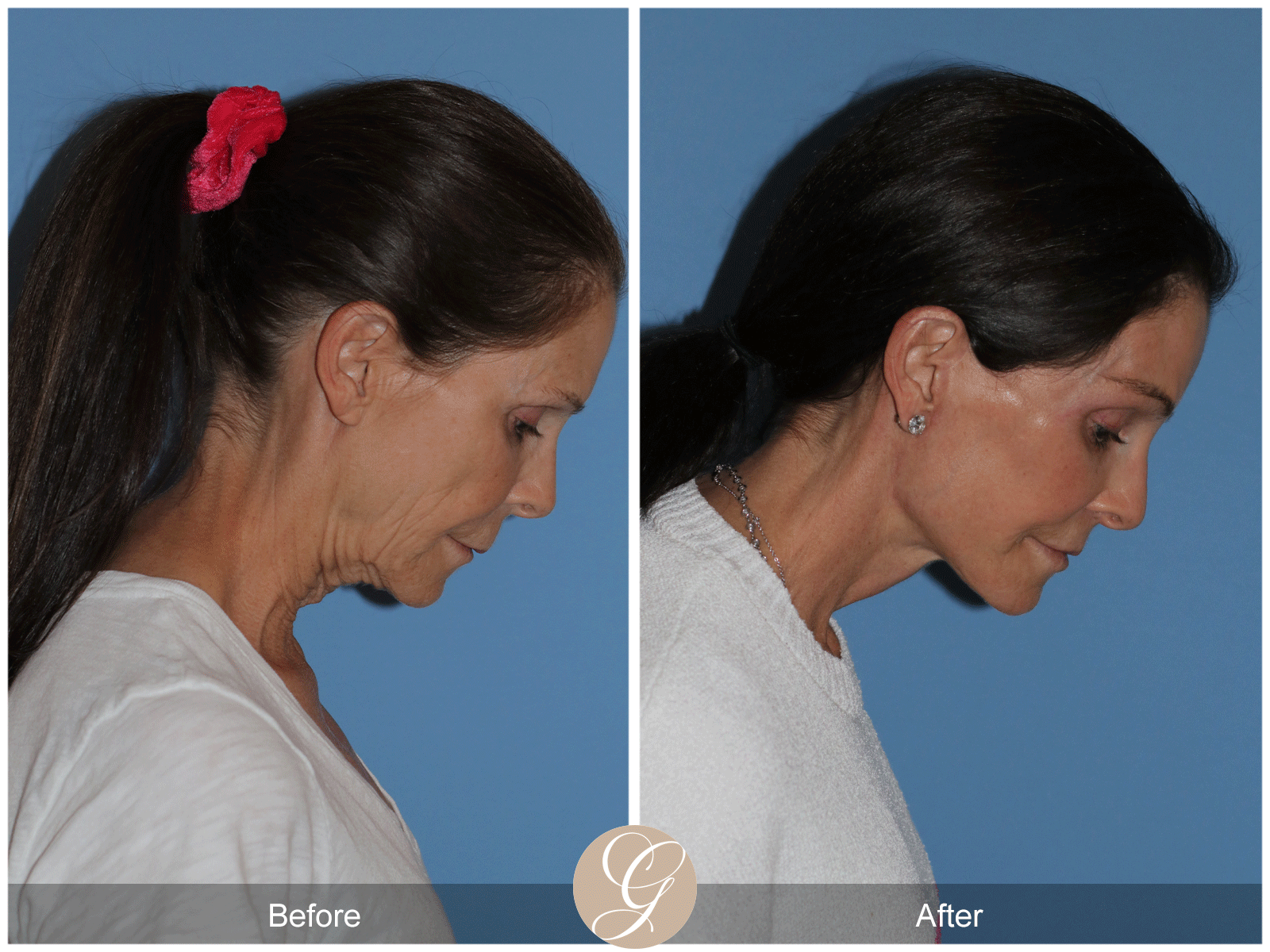 Deep Plane Facelift Case 46 Image