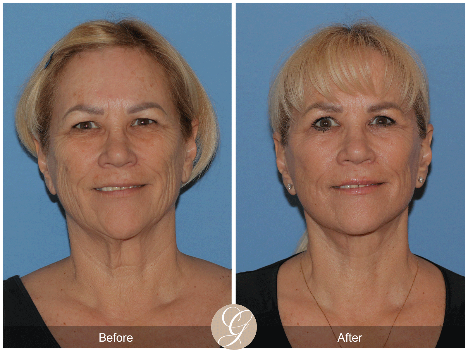 Deep Plane Facelift Case 38 Image