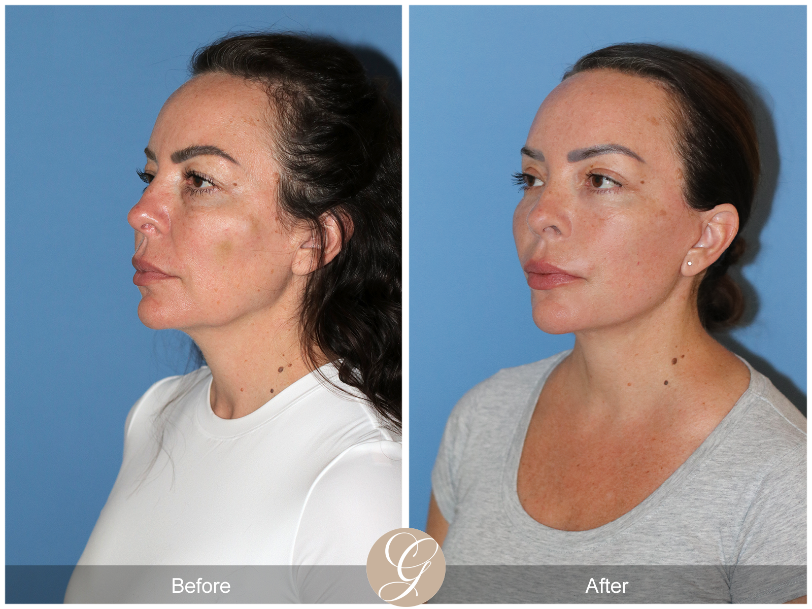 Preservation Deep Plane Facelift Case 46 Image